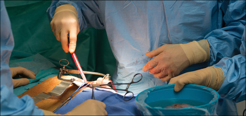 First Kidney Transplant Case performed under ABPMJAY Scheme at SKIMS
