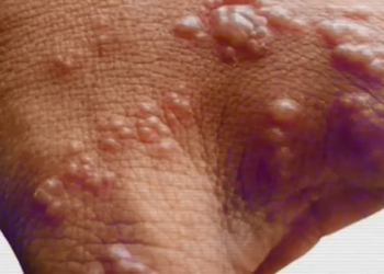 Cases of monkeypox in Canada’s Quebec rises to 132
