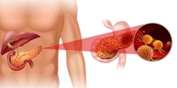 Processed meat risks pancreatic cancer’